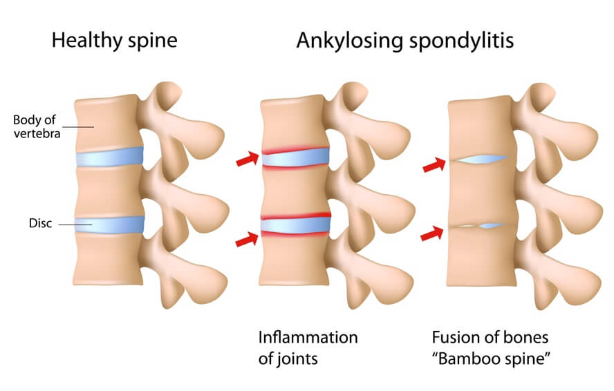Ankylosing Spondylitis: Autoimmune Disease: Signs & Symptoms Your Body Is Attacking Itself + Treatments | Dr. Jiwani's Naturopathic Nuggets Blog