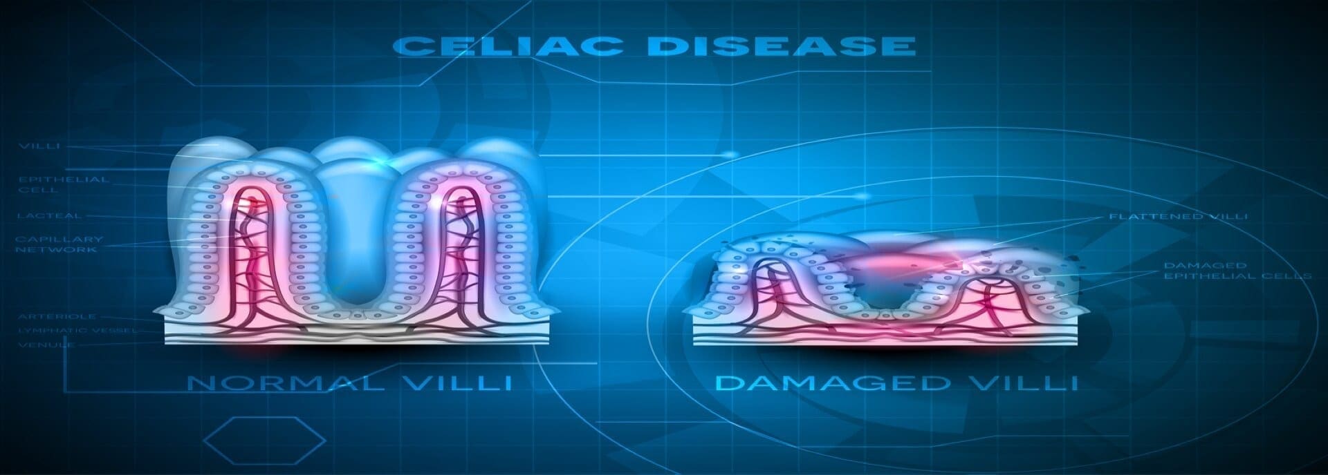 Do You Have Celiac Disease?  Signs & Symptoms Of This Autoimmune Gluten Epidemic | Dr. Jiwani's Naturopathic Nuggets Blog