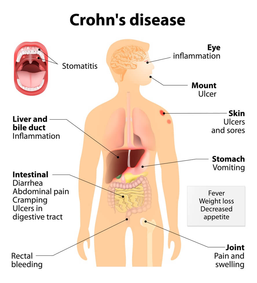 Crohn's Disease: Autoimmune Disease: Signs & Symptoms Your Body Is Attacking Itself + Treatments | Dr. Jiwani's Naturopathic Nuggets Blog