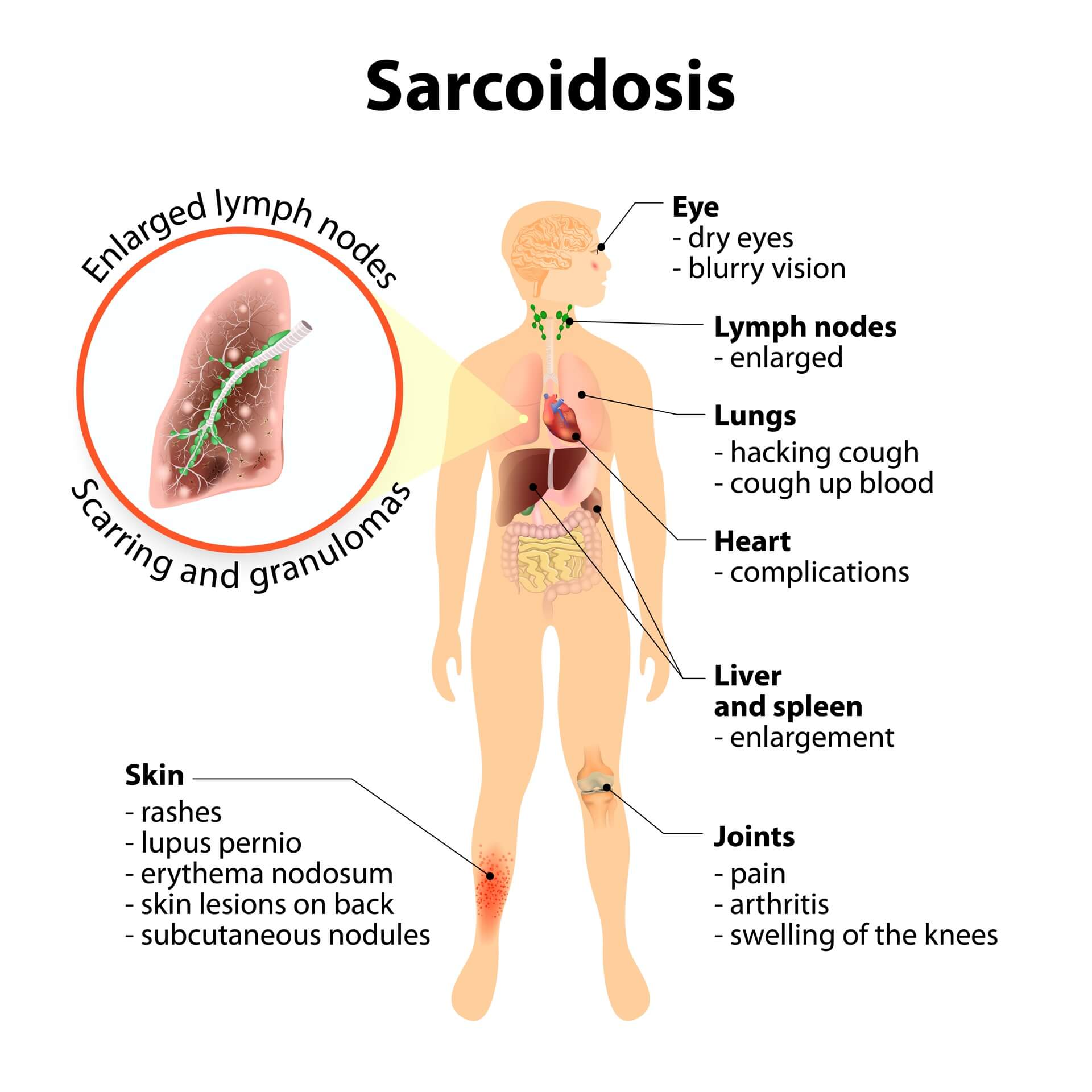 Sarcoidosis: Autoimmune Disease: Signs & Symptoms Your Body Is Attacking Itself + Treatments | Dr. Jiwani's Naturopathic Nuggets Blog