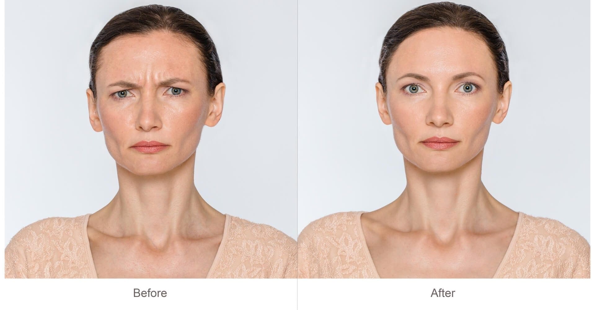 FAQ Botox Cosmetic Treatment Areas Pictures | Dr. Jiwani Naturopathic Vancouver Burnaby Surrey