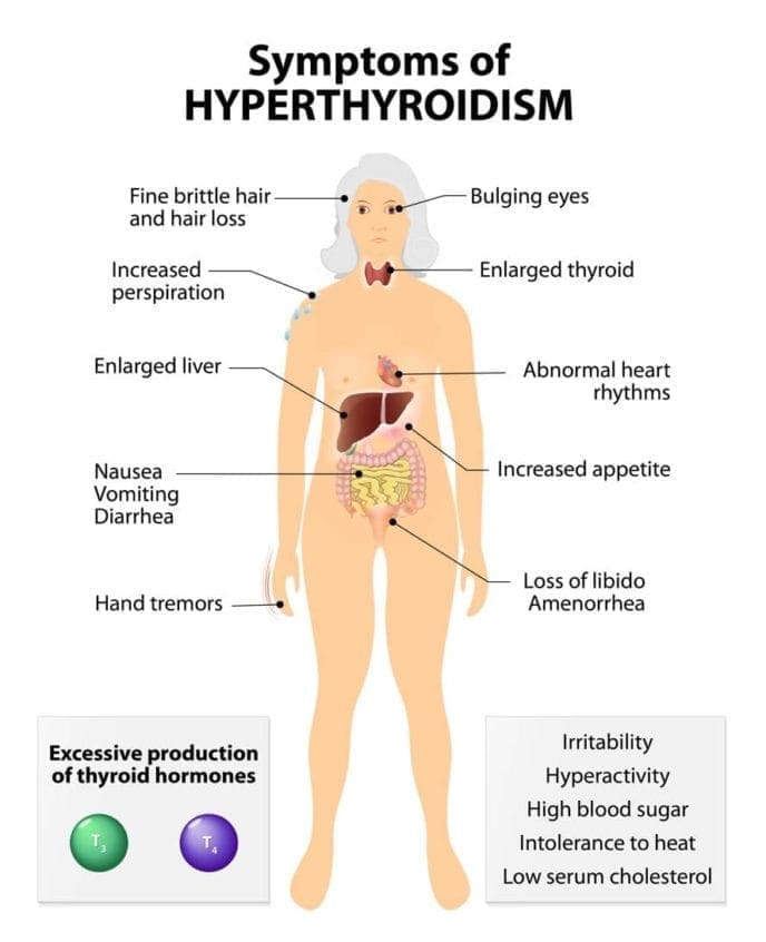 FAQ Thyroid Health Hyperthyroidism | Dr. Jiwani Naturopathic Vancouver Burnaby Surrey