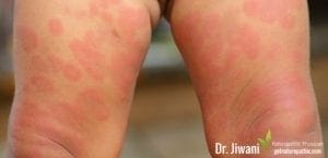 9 Surprising Symptoms Of Food Allergies: Skin Rashes | Dr. Jiwani's Naturopathic Nuggets Blog