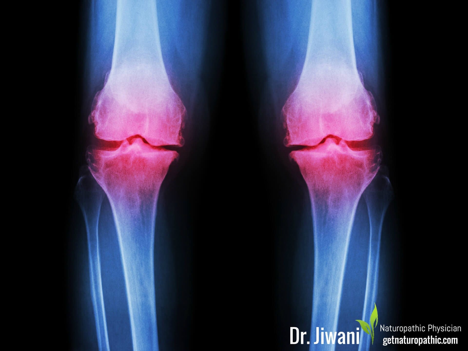 Osteoarthritis Sugar the Sweet Poison: The Alarming Ways Sugar Damages Your Body & Brain* | Dr. Jiwani's Naturopathic Nuggets Blog
