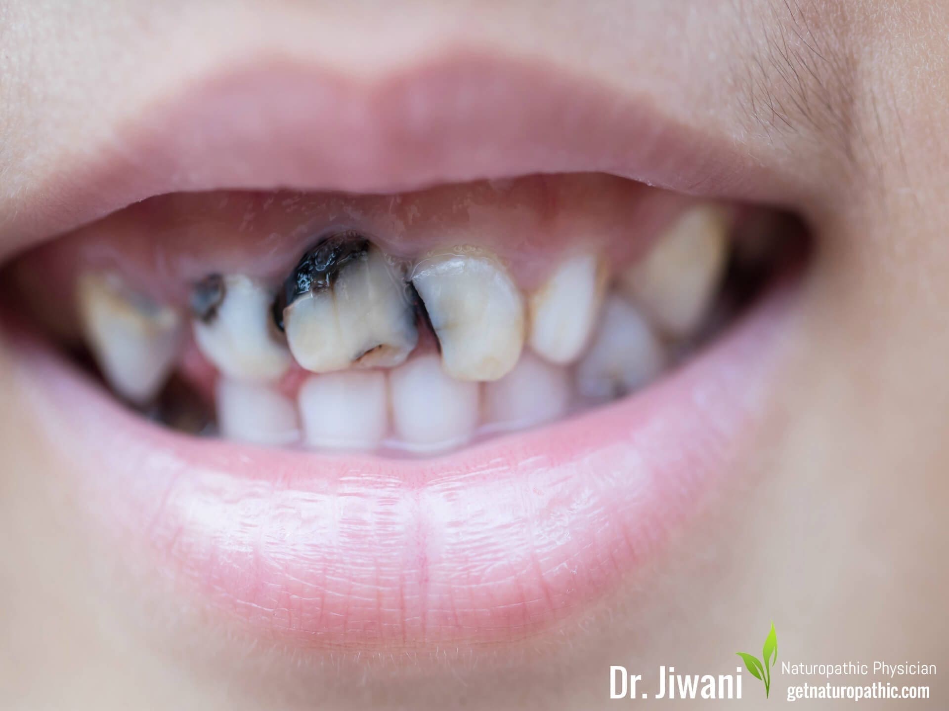 DrJiwani Tooth Decay Sugar the Sweet Poison The Alarming Ways Sugar Damages Your Body & Brain* | Dr. Jiwani's Naturopathic Nuggets Blog
