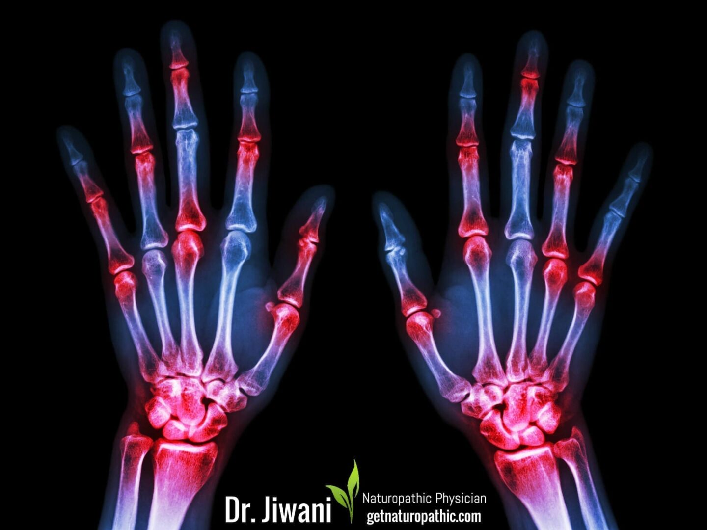 Intermittent Fasting for Health, Energy & Weight Loss Rheumatoid Arthritis* | Dr. Jiwani's Naturopathic Nuggets Blog