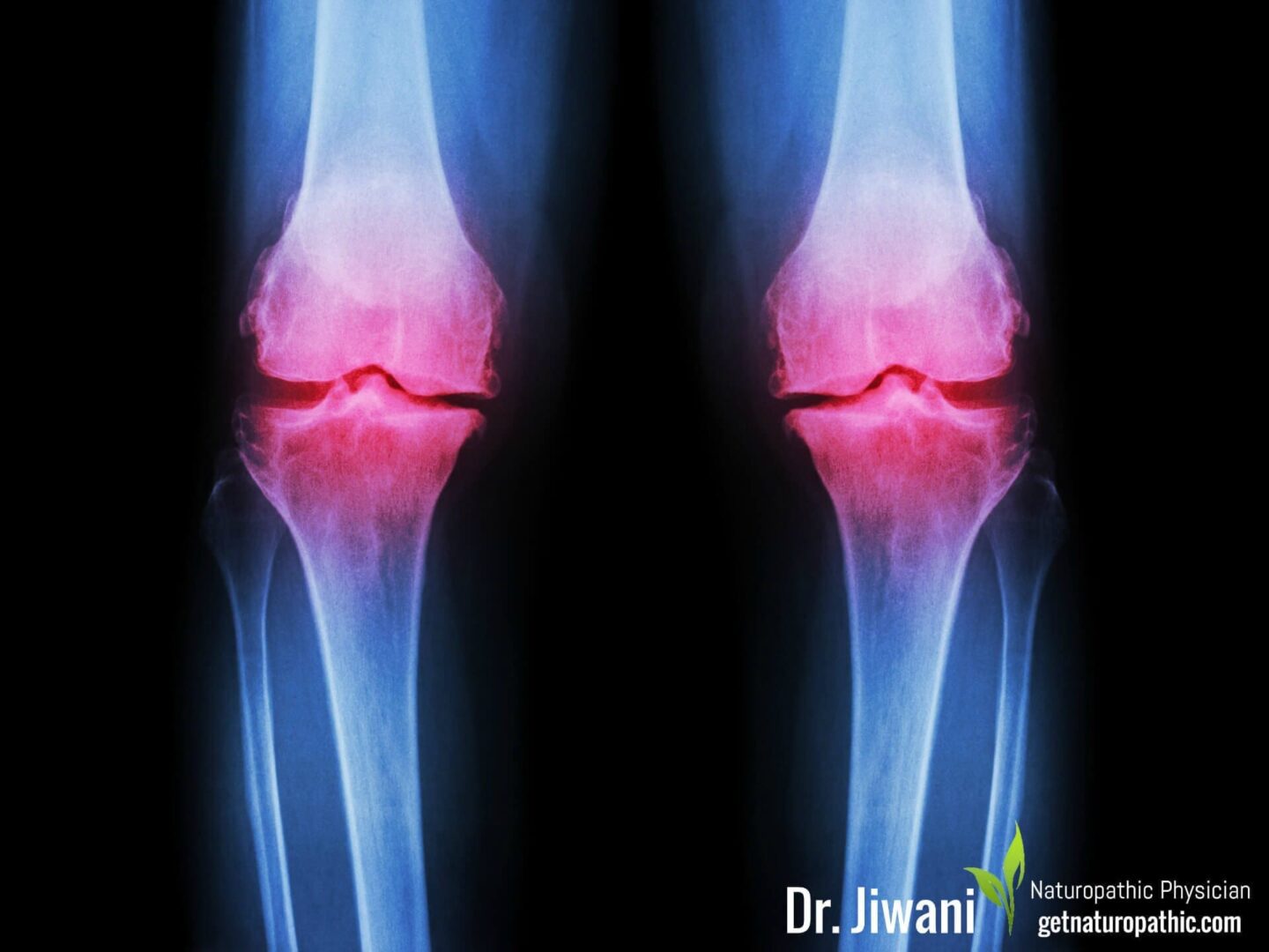 Prolozone Therapy: Natural Treatment for Joint Pain & Dysfunction | Dr. Jiwani's Naturopathic Nuggets Blog