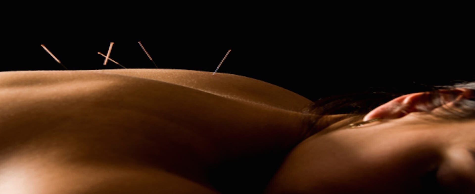  Acupuncture: The Ancient Asian Art of Healing | Dr. Jiwani Naturopathic Vancouver Burnaby Surrey